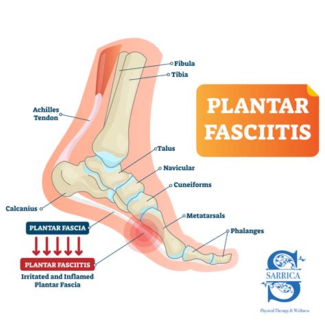 What is Plantar Fasciitis? — Sarrica Physical Therapy
