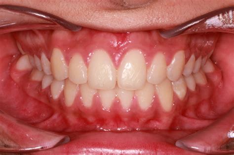 Ceramic braces - Oakland Aesthetics