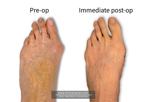 Dr. Nicholas Campitelli | Akron Podiatrist – Bunion Surgery – Dr
