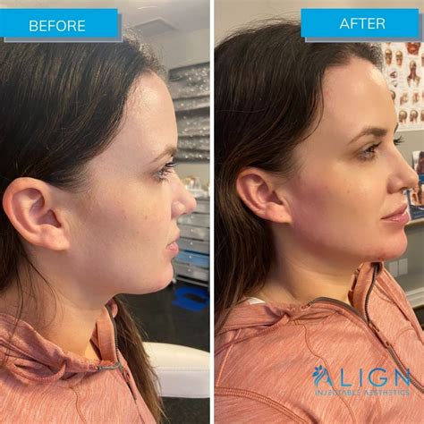 Before and After Jawline Filler | Align Injectable Aesthetics