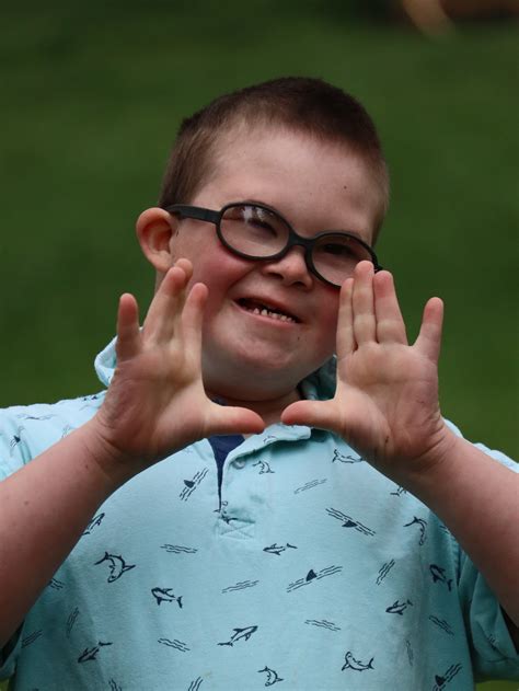 Down Syndrome Features But Not Down Syndrome at Rebecca Skinner blog