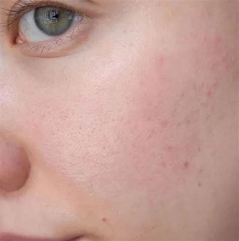 Acne - Nova Probiotics