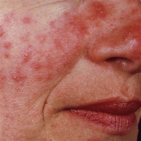 rosacea treatment red sensitive skin nascent skin clinic