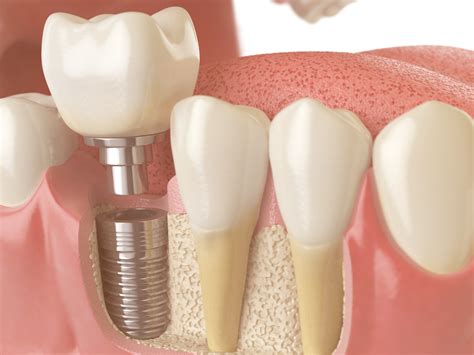 Dental Bone Graft After Wisdom Tooth Extraction at Jane Mcgary blog