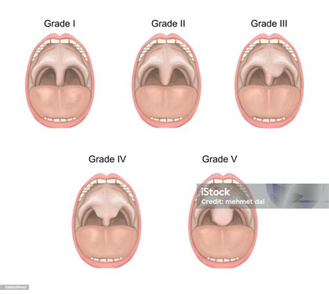 uvula anatomia uvula   uppp surgery