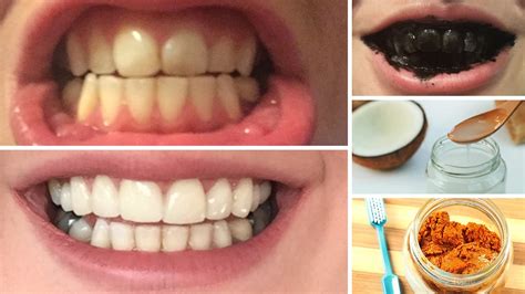 Teeth Treat: Teeth whitening home diy