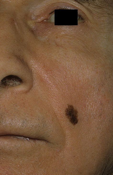 Лентиго меланома фото – 29 шт. / fotodiagnoz.com