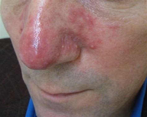 rosacea   rosacea facial redness