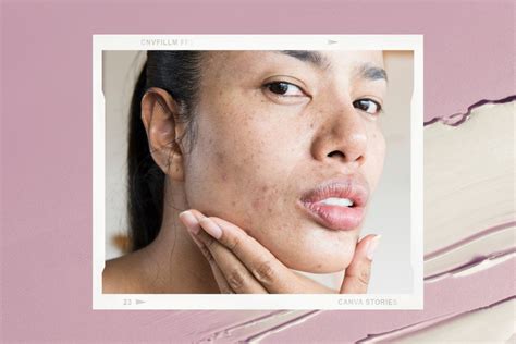 How to treat hormonal acne, according to a skin expert.