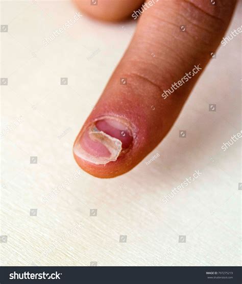 Nail Diseases Children Nail Diseases Small Stock Photo 797275219