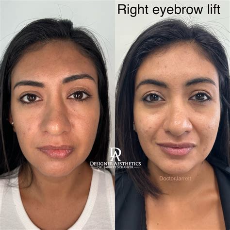 Eyebrows - Designer Aesthetics by Dr. Jarrett Schanzer | Miami