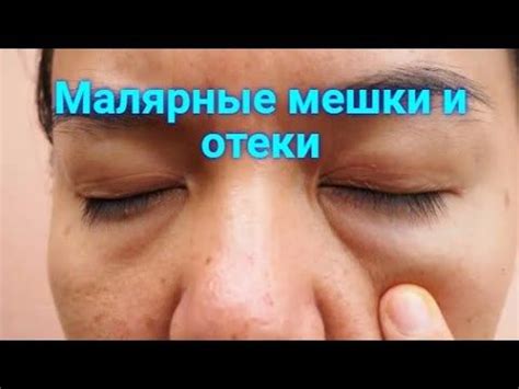 Малярные мешки и отеки под глазами. #1. Массаж от отеков под глазами ...