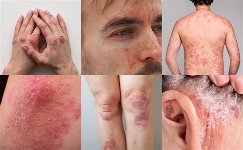 Actualité des dermatologues : Le psoriasis