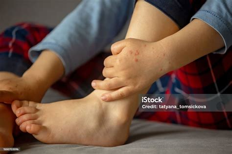 anak  ruam kulit roseola penyakit tangankakidanmulut enterovirus