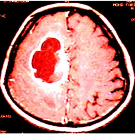 proceeding  glioblastoma multiforme gbm  advanced overview