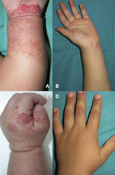 Infant 6 With Haemangioma Of The Forearm Before And After 3 Treatments