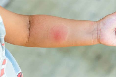 australian spider bite symptoms signs   aid stc