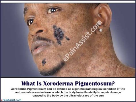 Xeroderma Pigmentosum: Treatment, Prognosis, Symptoms, Causes ...