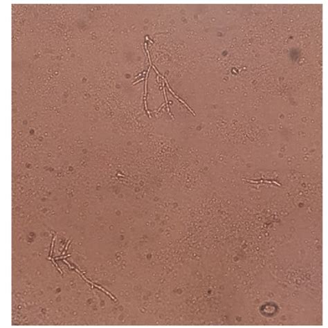KOH preparation of the pus, showing branched hyphae and budding yeast ...