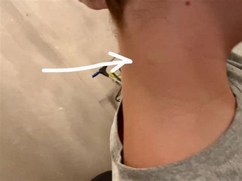 Lump in neck : r/medical