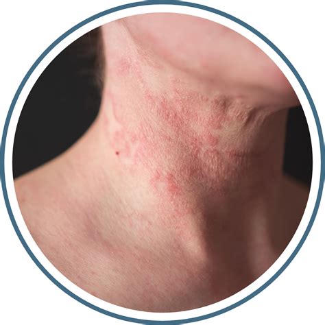 treatment  rashes eczema contact dermatitis georgia skin