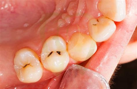 cavity    complete guide  recognizing tooth decay