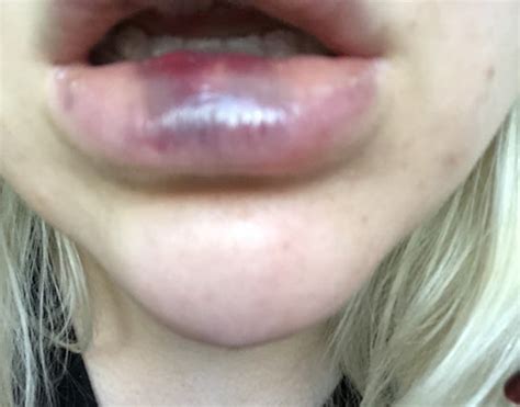 How Long Are Lips Bruised After Injections | Lipstutorial.org