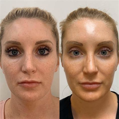 Best PRP-Microneedling Miami | World of Beauty