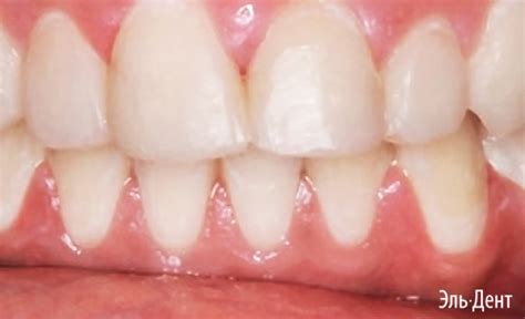 Harmonize Dentine A1 Syringe (шприц 4г) от Kerr. Гармонайз ...