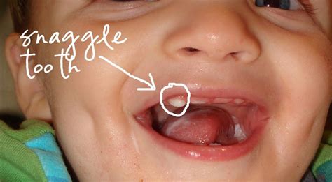 Momfessionals: Snaggle Tooth