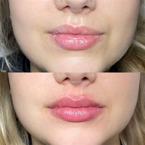 Botox For Square Jaw Reduction In Leatherhead, Surrey