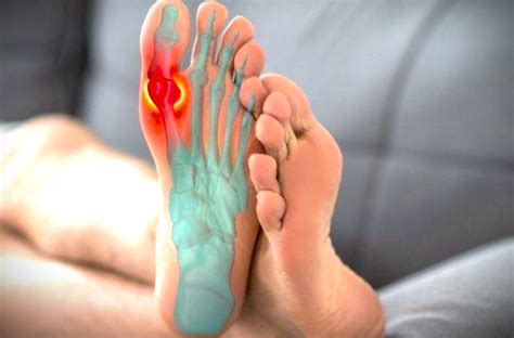 kenali gejala asam urat gout arthritis   pencegahannya