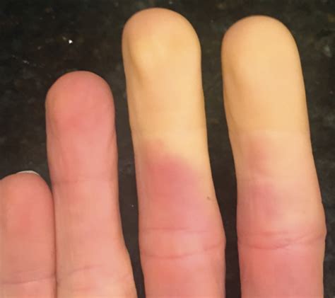cold induced conditions raynauds disease pediatric dermatology