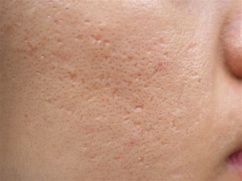 How to Get Rid of Acne Scars and Dark Spots | PanOxyl