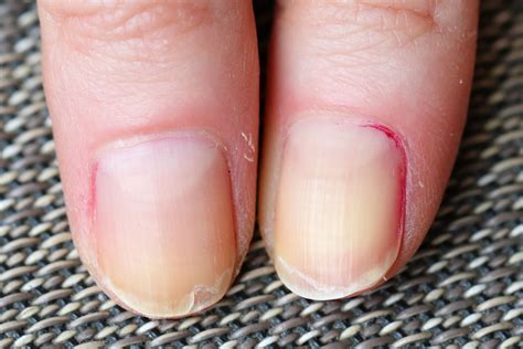 Raised Bumps On Fingernails