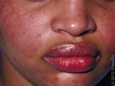Lupus Rashes (With Pictures): What It Is and How to Treat It - GoodRx