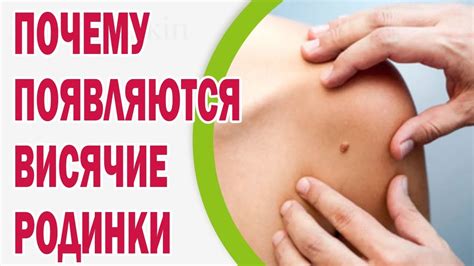 Почему на теле появляются висячие родинки - YouTube