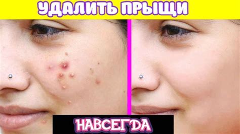 Как Избавиться от Прыщей и Угрей Раз и Навсегда | How to remove pimples ...