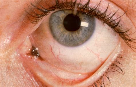 Early Conjunctival Melanoma