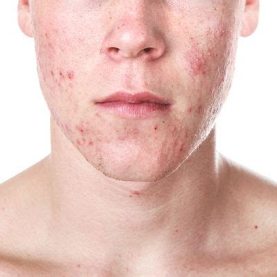 acne spots west yorkshire healthier