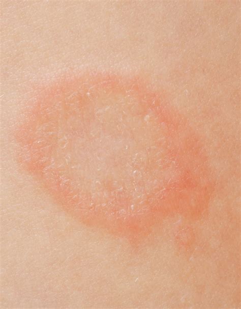 Fungal, Yeast, and Viral Infections - Gem State Dermatology