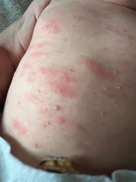 Erythema toxicum neonatorum | BabyCenter