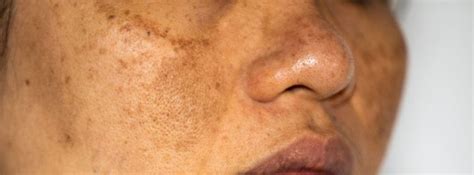 how long does it take for hyperpigmentation to go away
