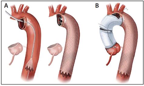 Hybrid Techniques for Surgical Repair of Acute Type A Aortic Dissection - Endovascular Today