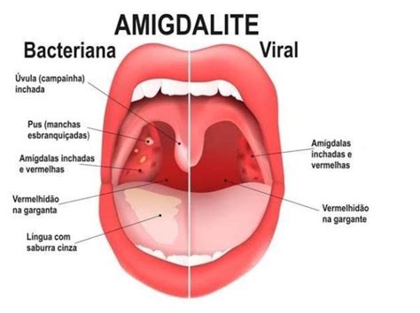 Quando A Garganta Ta Inflamada