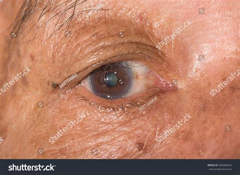 184 Entropión Images, Stock Photos & Vectors | Shutterstock