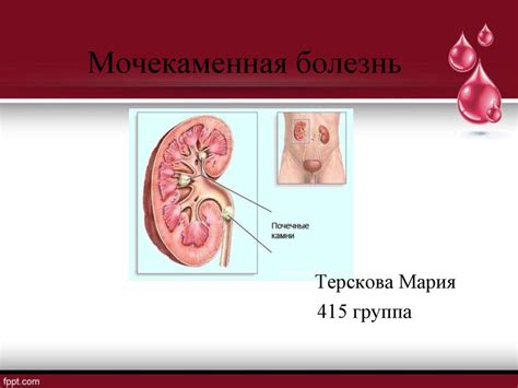 Мочекаменная болезнь - презентация онлайн