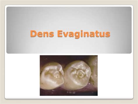 Dens evaginatus