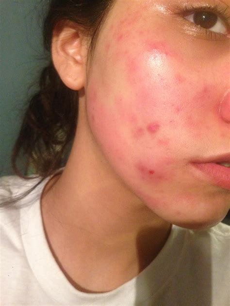 [Skin Concern] Am I having an allergic reaction? : r/SkincareAddiction