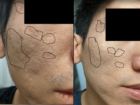 Review of the phenol peel (1+ year later) - Scar treatments - Acne.org